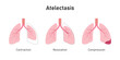 Atelectasis Lung Disease Concept Design. Vector Illustration.