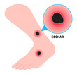 © Pepermpron - Foot leg wounds and skin infection with eschar or scrub typhus the bacteremia hand sepsis in diabetes patient