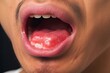 Aphthous ulcer, canker sore or stress ulcer in the mouth of Asian male patient, Generative AI