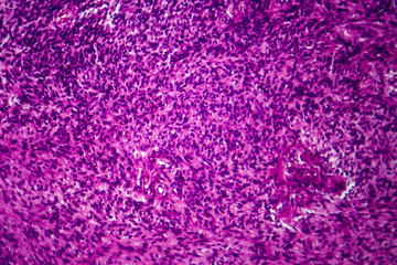 Wall Mural - Fibrosarcoma, light micrograph