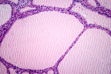 Poster - Endemic goiter, light micrograph