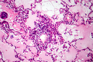 Poster - Lung adenocarcinoma, light micrograph