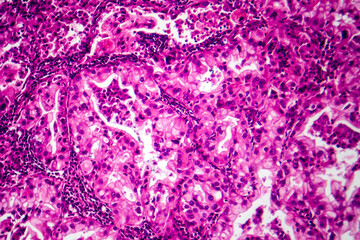 Sticker - Lung cancer tissue, light micrograph