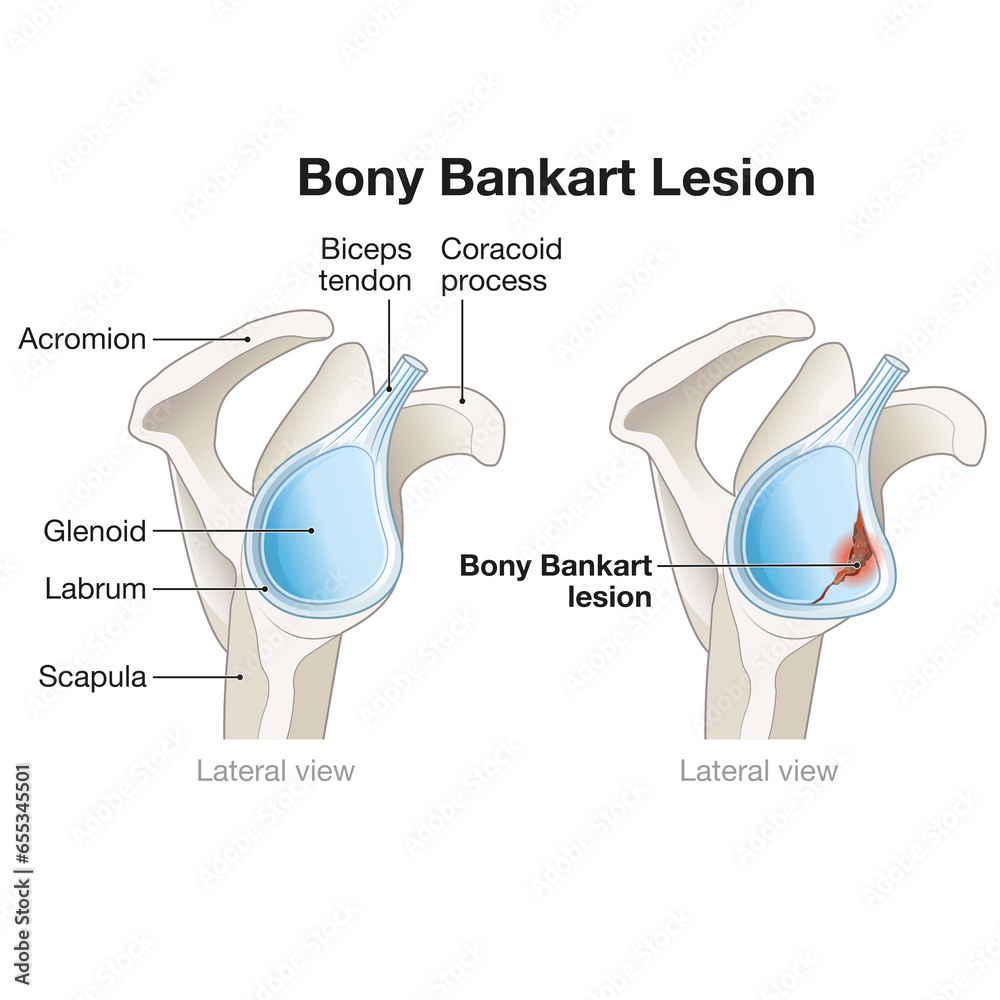 bony bankart lesion left shoulder icd 10