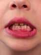 dental structure disorder in children, a child's teeth being in the shape of a saw,