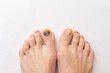 Subungual hematoma present under the toenail of the hallux, more commonly known as the big toe. broken toenail is when blood forms under a fingernail or toenail. Blue black toenail.