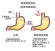 胃食道逆流症のイラスト