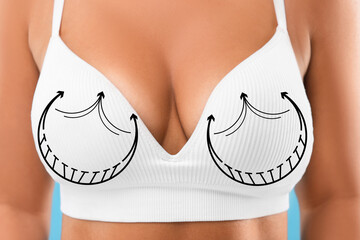 Poster - Breast surgery. Woman with markings on bra, closeup