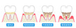 歯周病の進行　症状