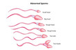 Biological Anatomy of Abnormal Sperms (classification of Abnormal sperm), sperm morphology, forms of sperm 