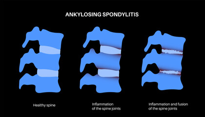 Sticker - Ankylosing spondylitis disease