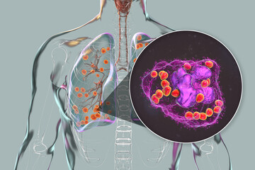 Canvas Print - Lung histoplasmosis, a fungal infection caused by Histoplasma capsulatum, 3D illustration