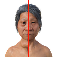 Wall Mural - A woman with Graves' disease and the same healthy person, 3D illustration