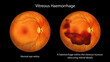 © Dr_Microbe - Vitreous hemorrhage as observed during ophthalmoscopy, illustration