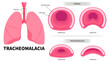 Lung anatomy with trachea exhalation inhalation breathe in common cold