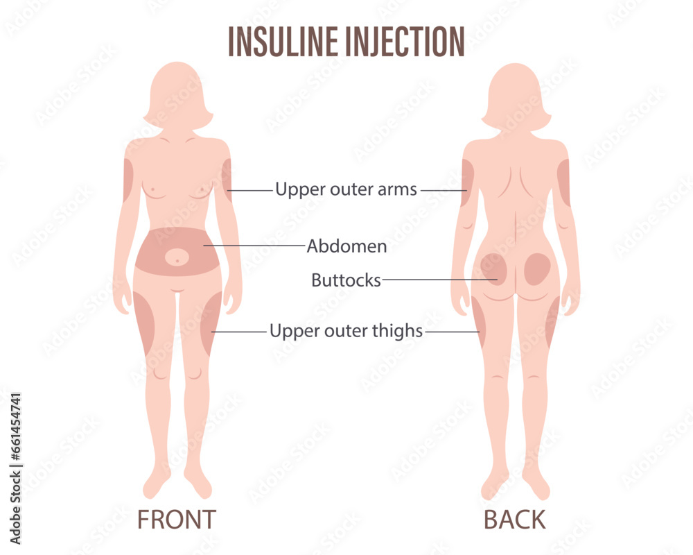 Diabetes. Insulin injection sites on the human body, upper arms ...
