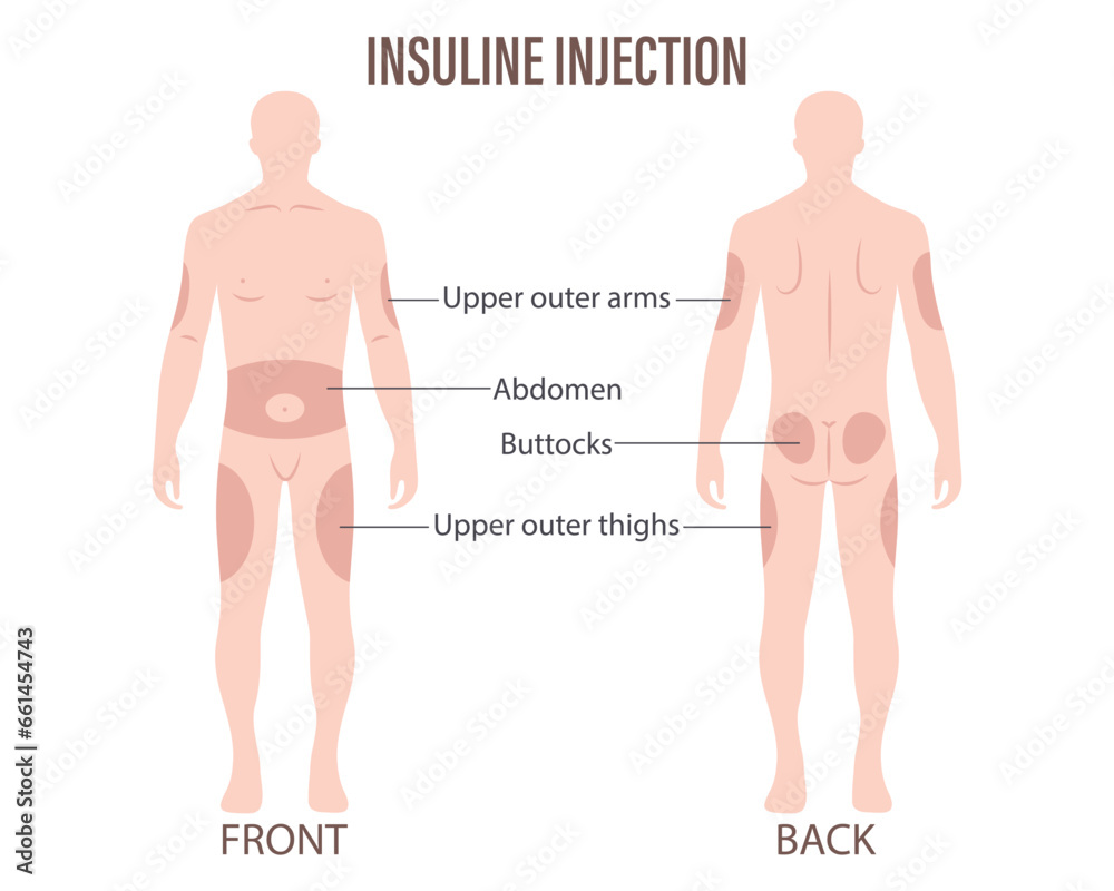 Diabetes. Insulin injection sites on the human body, upper arms ...