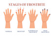 Frostbite stages. Frozen hands in different stages. Medical frostbite. Skin burn symptom. Health care medical concept. Vector