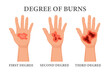 © Tatiana - Burn stages. Burnt hands at various degrees. Skin burn symptoms. Medical healthcare concept. Vector