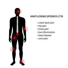 Canvas Print - Ankylosing spondylitis disease