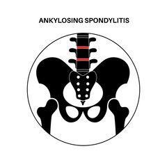 Poster - Ankylosing spondylitis disease