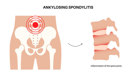 Canvas Print - Ankylosing spondylitis disease