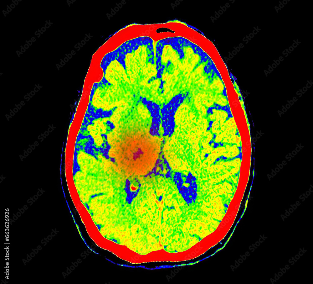 CT Brain Perfusion or CT scan image of the brain axial view showing ...