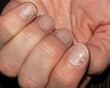 The recovery process of a Caucasian hand after scarlet fever, displaying nail damage and renewal