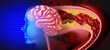 Brain Stroke Attack as a Cerebral arteriosclerosis disease as a blocked artery due to plaque buildup