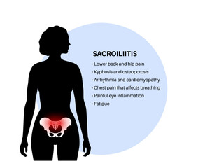 Canvas Print - Sacroiliitis medical poster