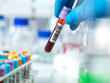 © Westend61 - Pathologist holding blood collection tube in laboratory