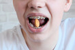 Teenager young man, European, close-up of braces on his teeth. Biting almond nuts. Concept of dental hygiene, prosthetics, permitted products for braces.