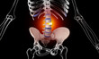 Bulging disc spinal injury skeleton 
medical illustration