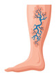 Stages or types of varicose veins development. Medical poster or disease infographic. Image of diseased legs. Vector illustration in flat style
