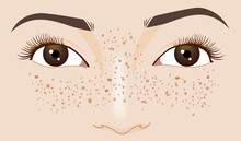 Freckle Spot On Caucasian Woman's Face, Zoom In Illustration