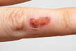 © Alessandro Grandini - female hand with impetigo, a bacterial infection that causes skin lesions