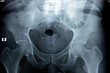 Hip joints digital radiographic examination reveals normal appearance of hip joins, multiple pelvic phleboli, bilateral coxa profunda, preserved spherical contour of femoral head, selective focus