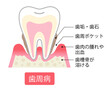 歯周病　断面図