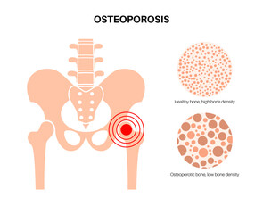 Canvas Print - Osteoporosis medical poster