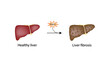 Liver fibrosis. Liver injury. Hepatic stellate cell, HSC. Vector illustration.