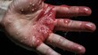 Wet hand from sweat syndrome due to hyperhidrosis. Isolated on dark background