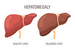 Hepatomegaly, liver diseases. Healthy liver and enlarged liver. Medical infographic banner. Vector