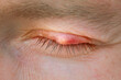 Burst abscess, inflamed area of the eyelid. Chalazion, slow-growing lump or cyst that develops within the eyelid. Eye diseas with swollen, inflamed eyelid. Chalazion on upper eyelid closeup.