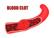 Blood clots are clumps that occur when blood hardens from a liquid to a solid. A blood clot that forms inside one of your veins or arteries is called a thrombus. A thrombus may also form in your heart