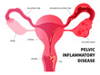 © Pepermpron - pelvic inflammatory disease and bacteria infection with ovary vagina painful