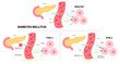 Glucagon hormone of Diabetes mellitus type 1 and 2 with insulin injection diagram of chronic metabolism disease anatomy