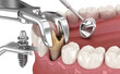 Extraction and Implantation, complex immediate surgery. Medically accurate 3D illustration of dental treatment