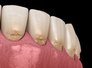 Wall Mural - Teeth abfraction. Dental 3D illustration