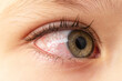 Closeup irritated infected red bloodshot eyes, conjunctivitis