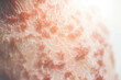 © Maris - Dermatology Close-Up: Detailed Psoriasis Skin Surface with Red Patches